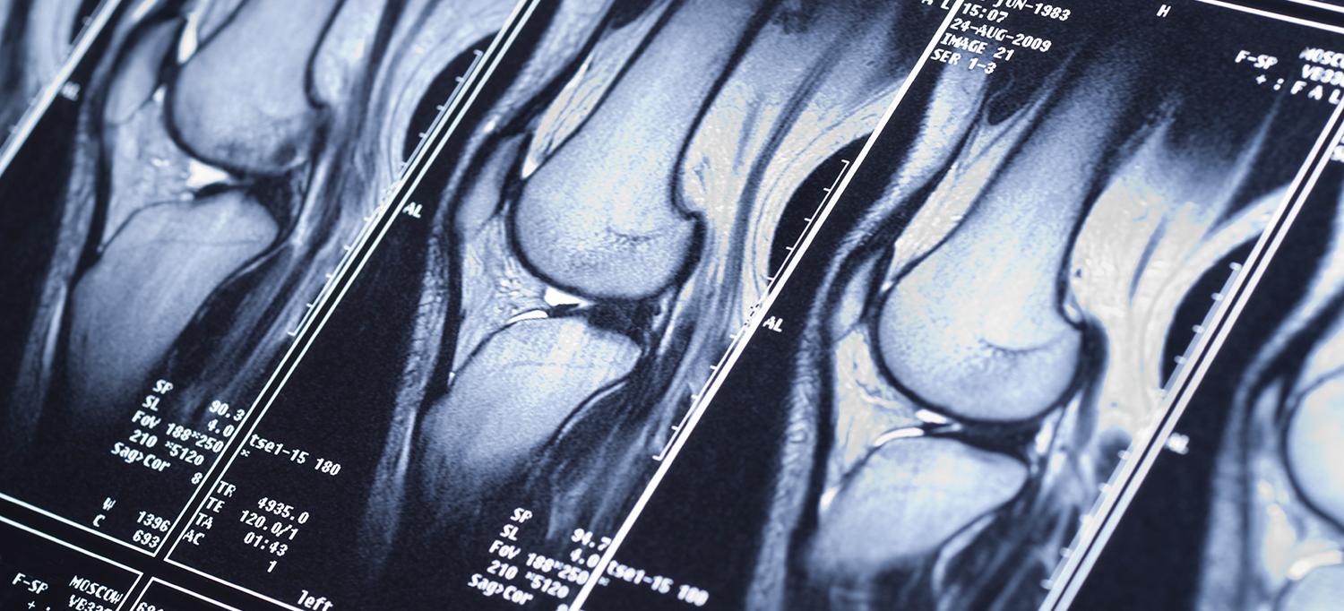 MRI Results from Knee Scan