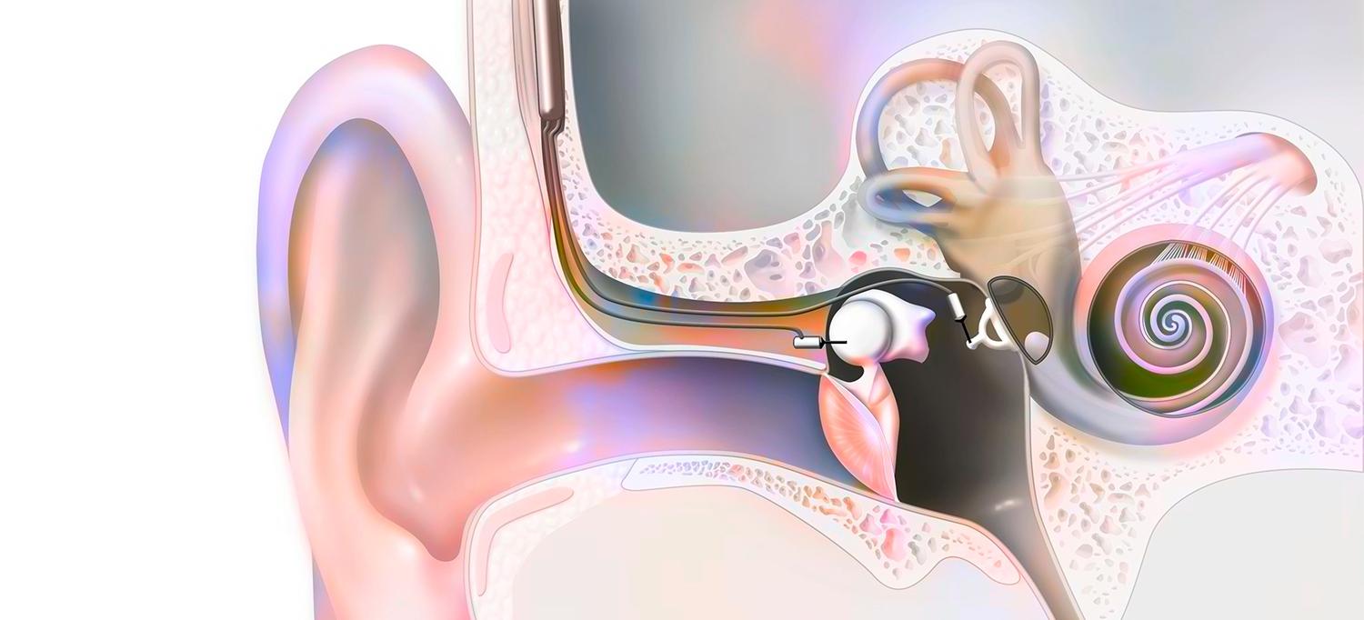 Illustration of Cochlear Implant in Inner Ear