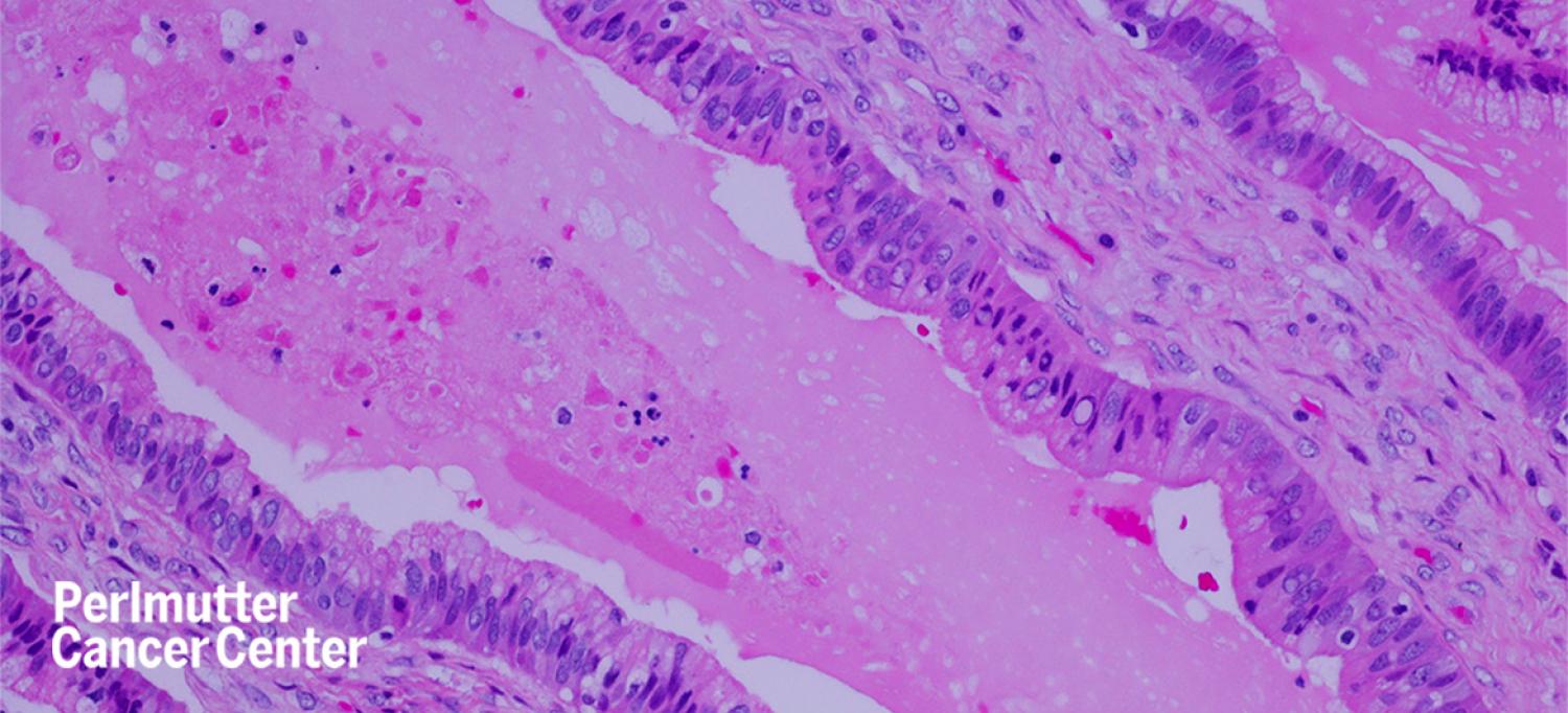 Microscopic view of metastatic pancreatic ductal adenocarcinoma