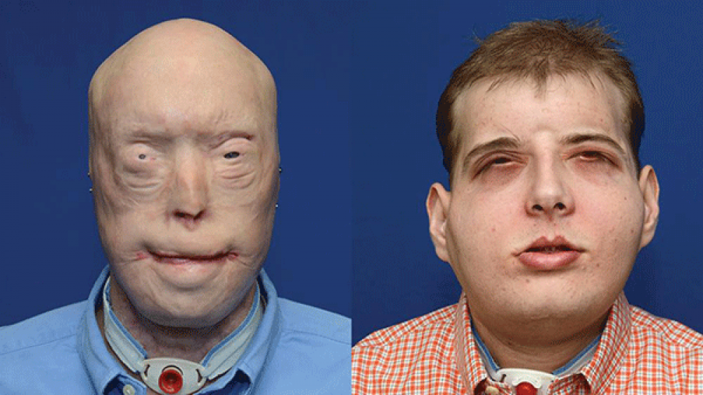 Patrick Hardison Before and After Surgery