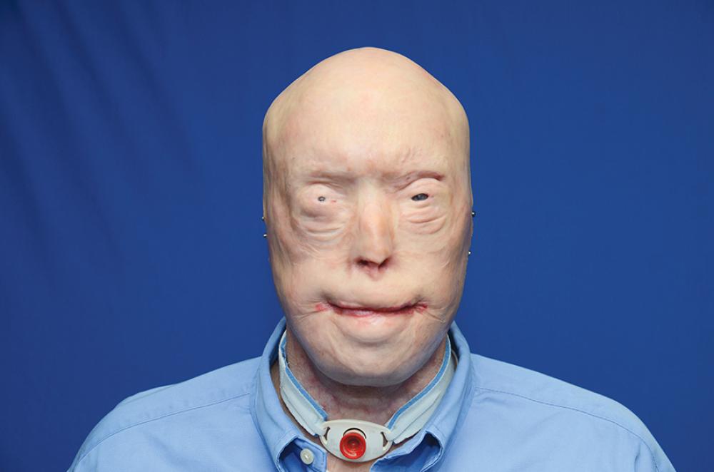 Patrick Hardison Before His Face Transplant Procedure