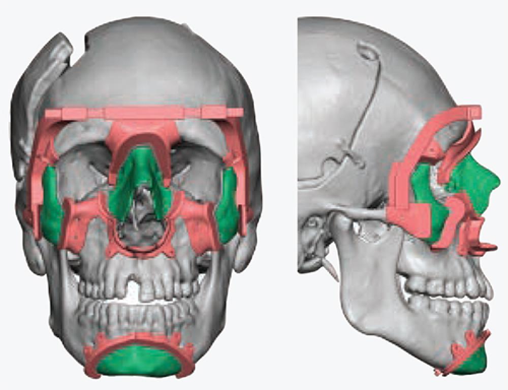 Face Transplant Surgical Cutting Guides