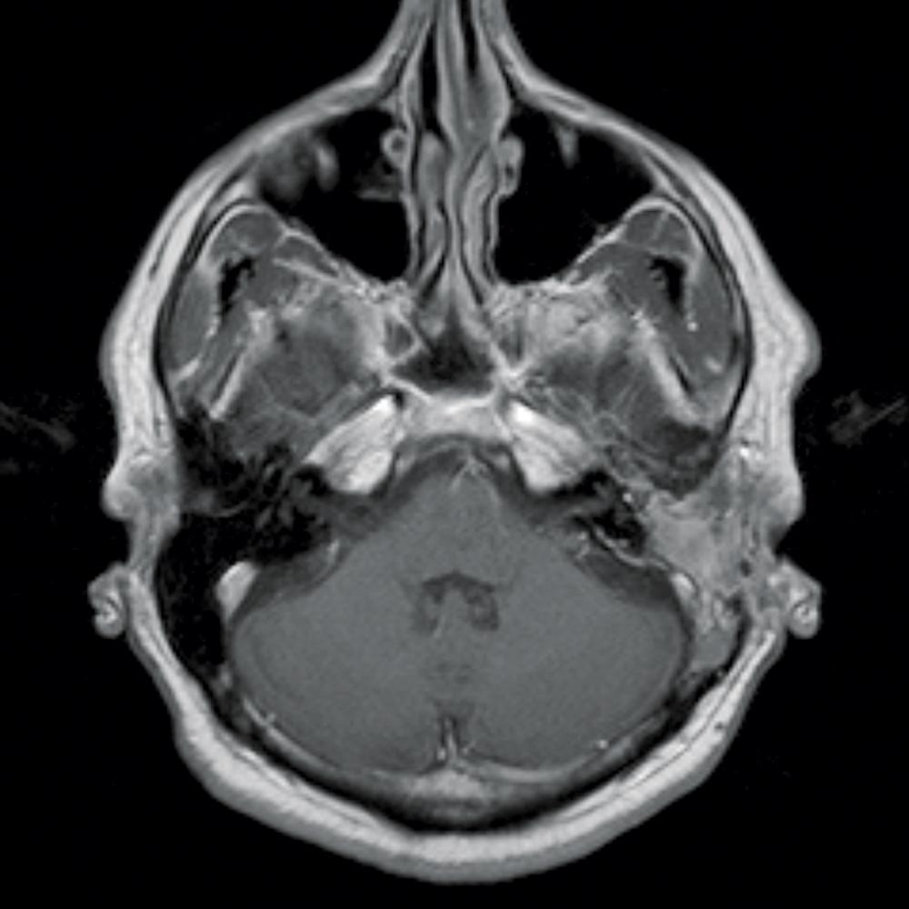 Postoperative MRI After Tumor Removal