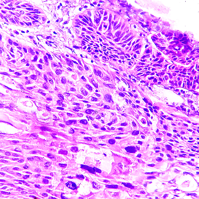 Diagnosing Endometrial Cancer