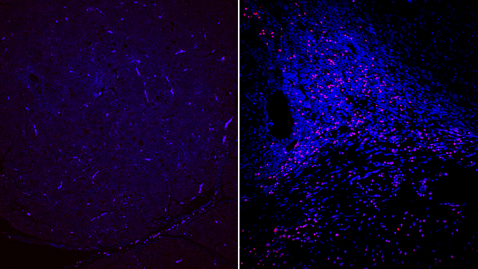 Normal and cancerous pancreatic tissue. The blue background represents the cells that produce digestive juices supplied by the pancreas to the gut, and the red dots—seen only in the cancerous pancreas—represent the bacteria found to be a thousand times more abundant than normal.