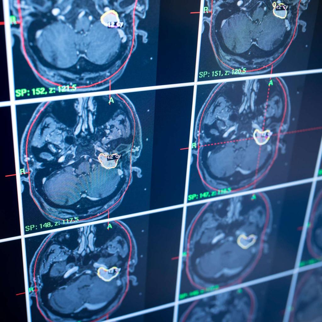 Meningioma | NYU Langone Health