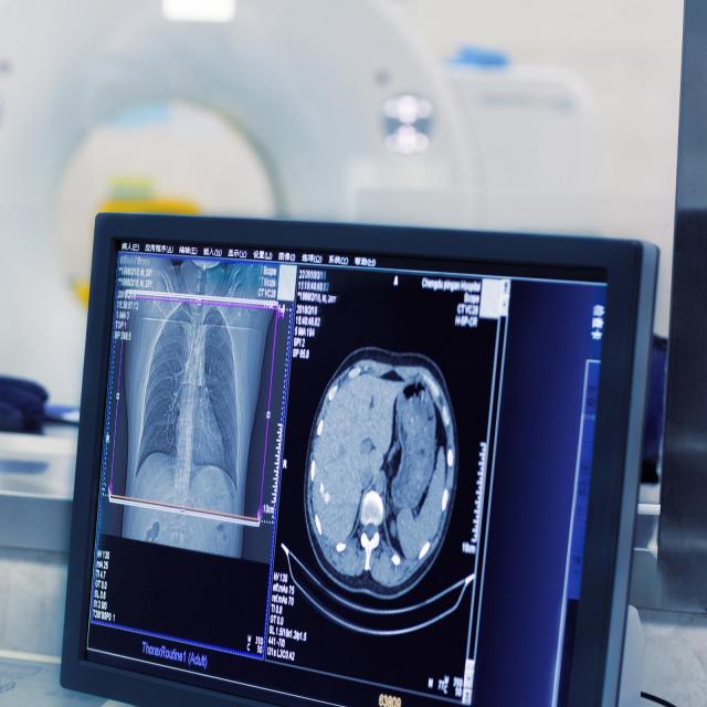 NonSmall Cell Lung Cancer NYU Langone Health