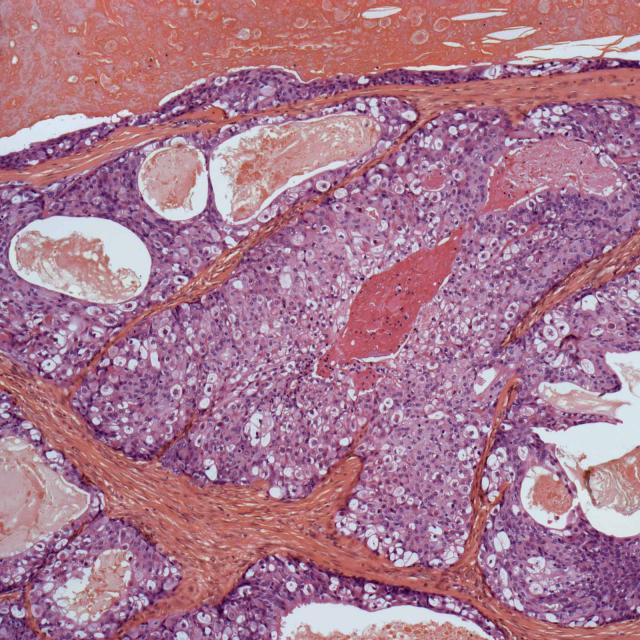 Salivary Gland Cancer NYU Langone Health