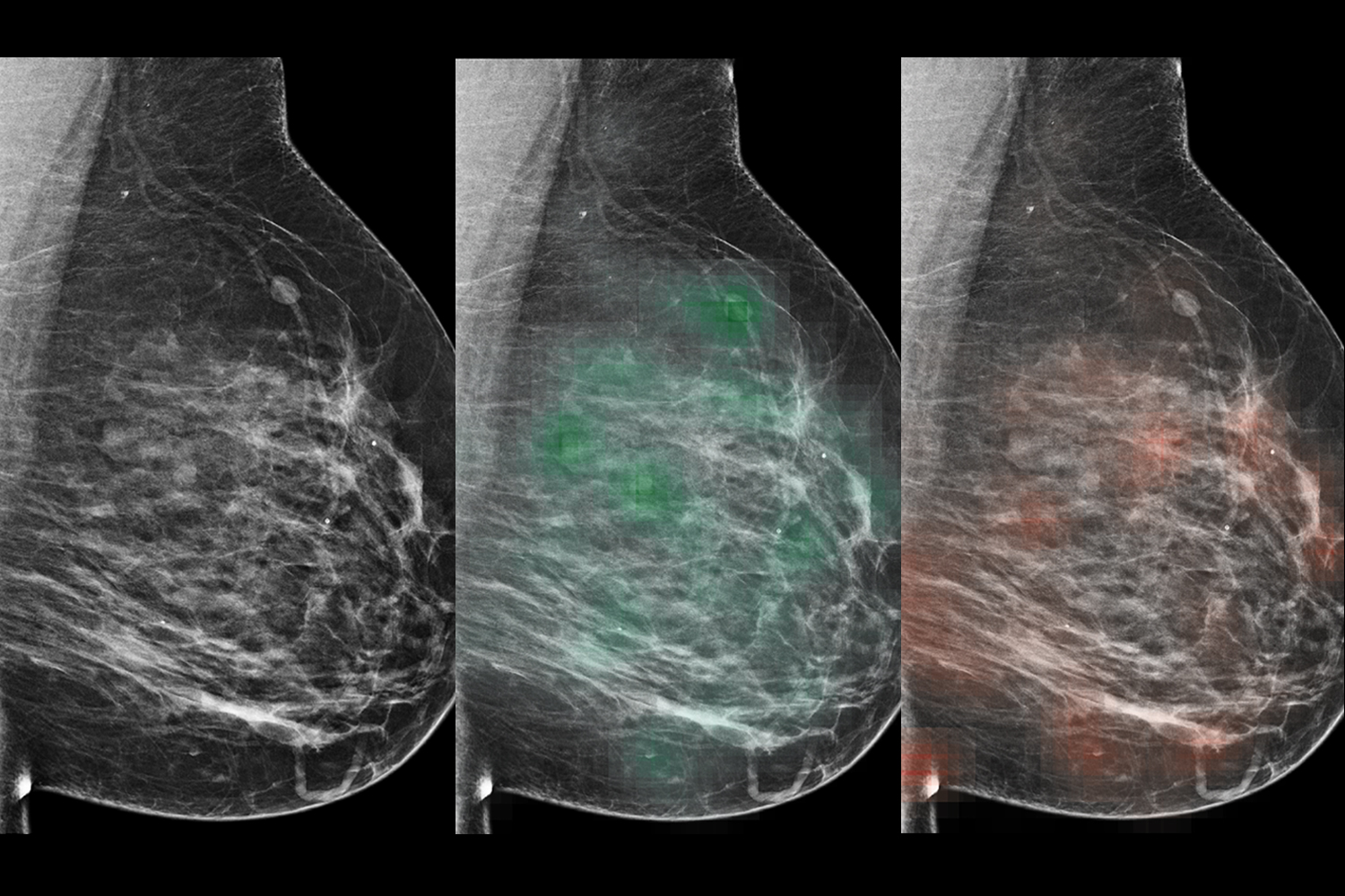 How artificial intelligence is being used to detect breast cancer