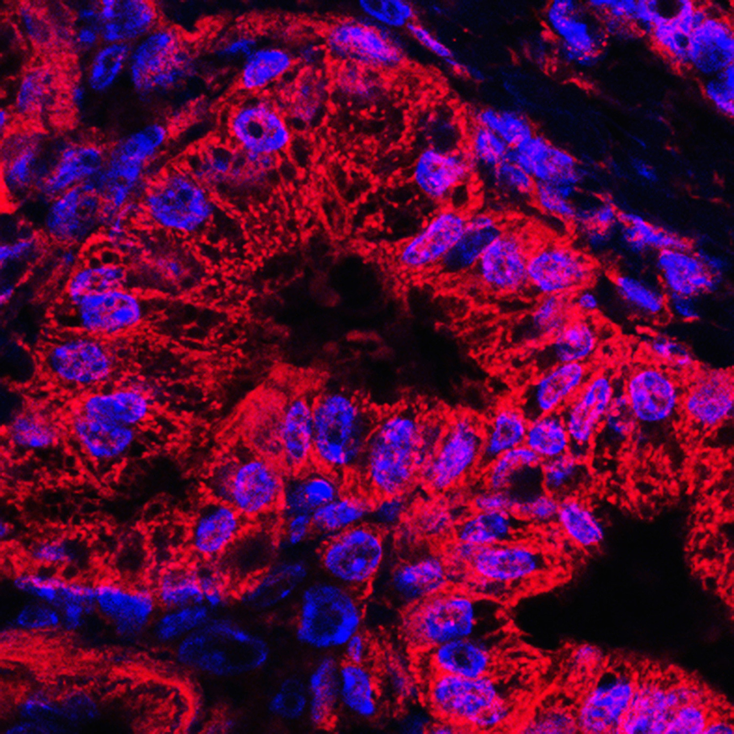 Nerves Keep Pancreatic Cancer Cells from Starving | NYU Langone News