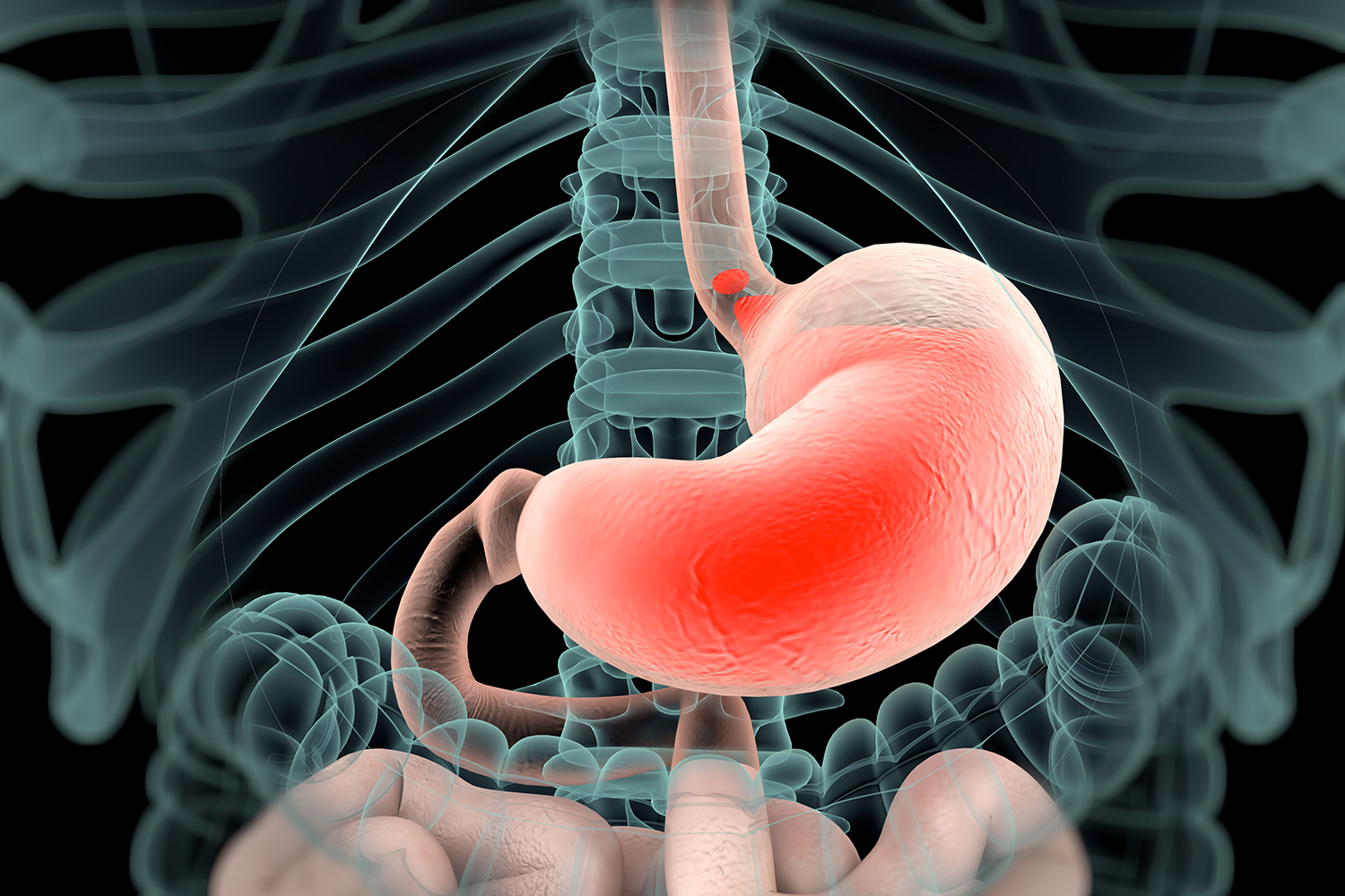 team-resolves-refractory-gastroesophageal-reflux-disease-recurrent