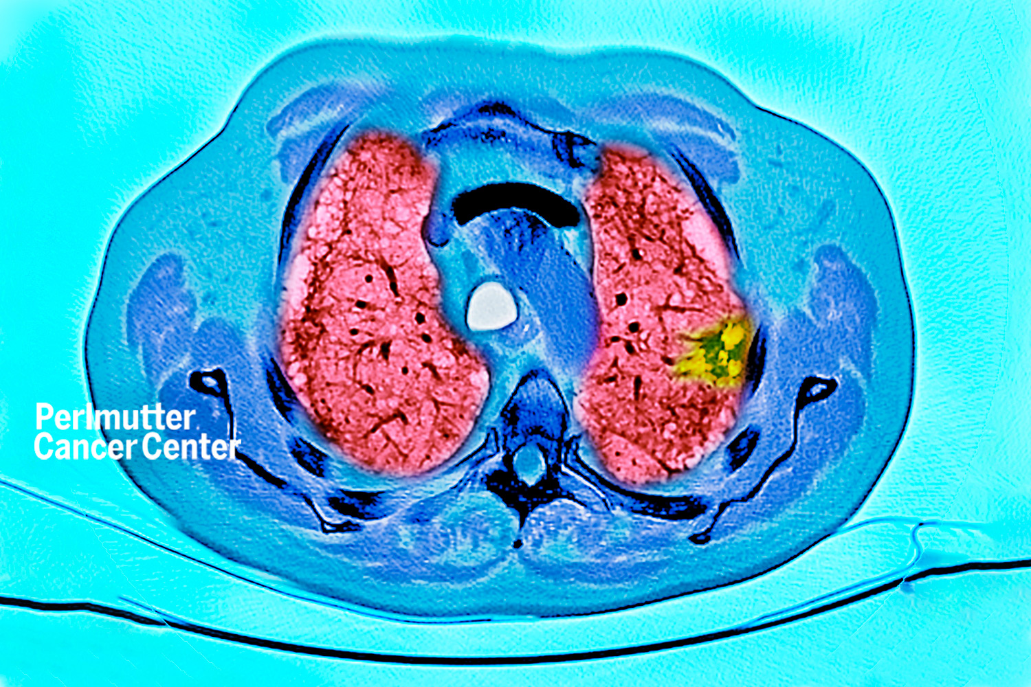 Lung Cancer Screening Program Expands Across NYU Langone’s Outpatient ...