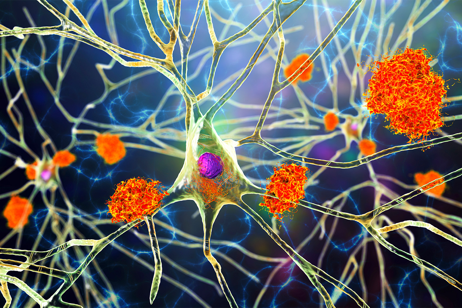 Toxic Fatty Acids To Blame For Brain Cell Death After Initial Injury 