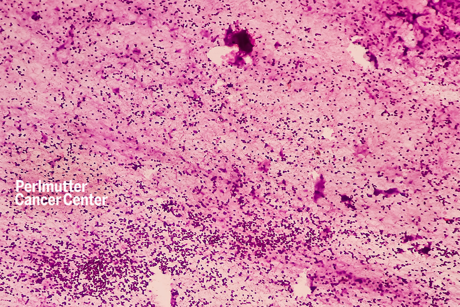 News 12 Brooklyn Perlmutter Cancer Center Thoracic Surgeon Discusses