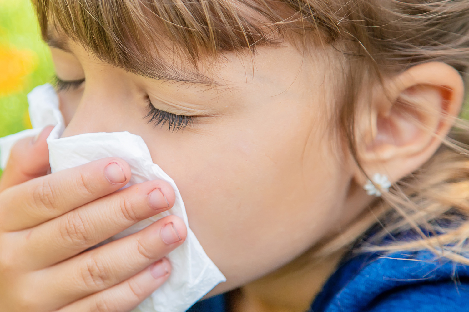 Six Surprising Truths About Kids Allergies NYU Langone News