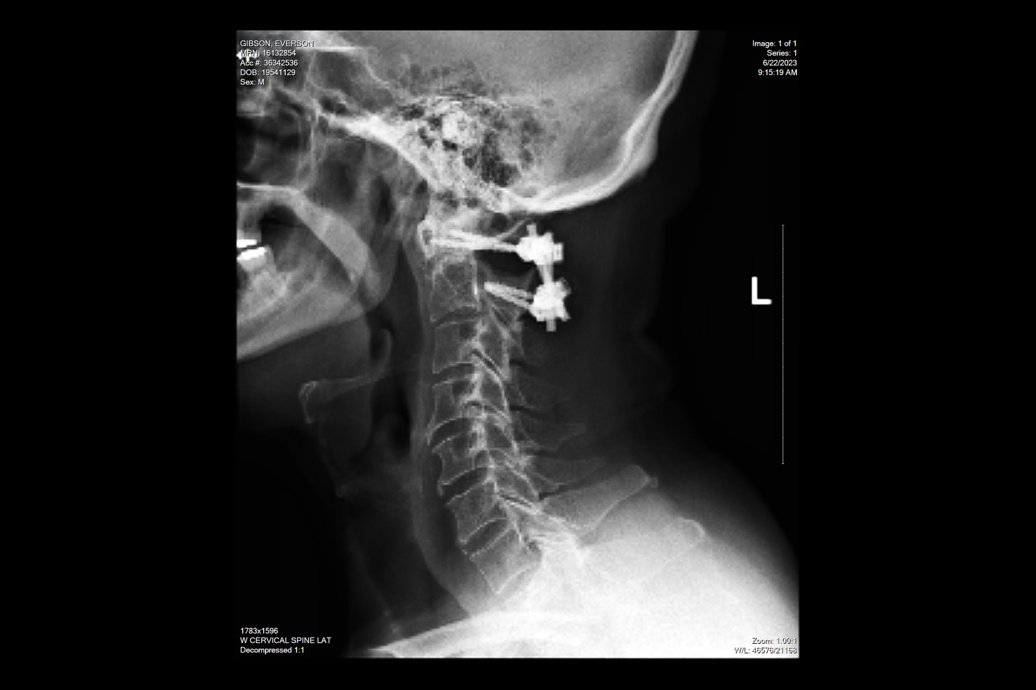 Neck (Cervical Spine) fracture - After Trauma