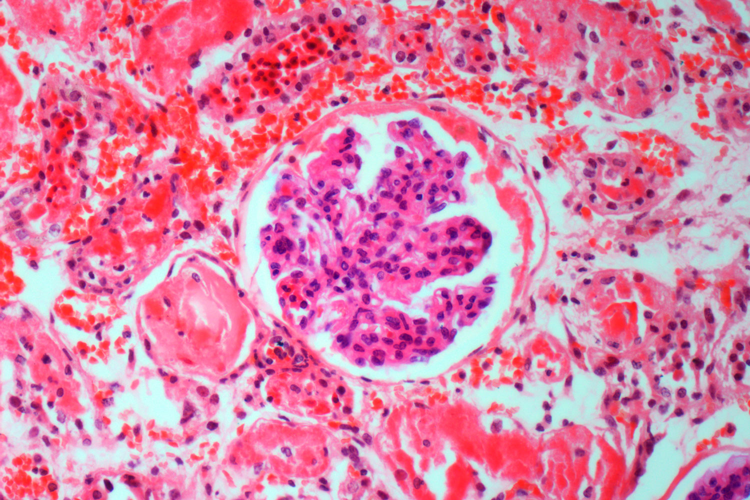 Disagreement Between Two Kidney Function Tests Predicts Serious Health Problems
