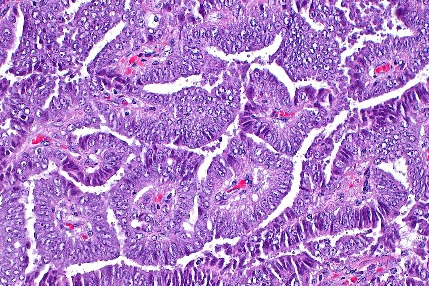 Blocking Key Protein Triggers Cancer Cell Self-Destruction