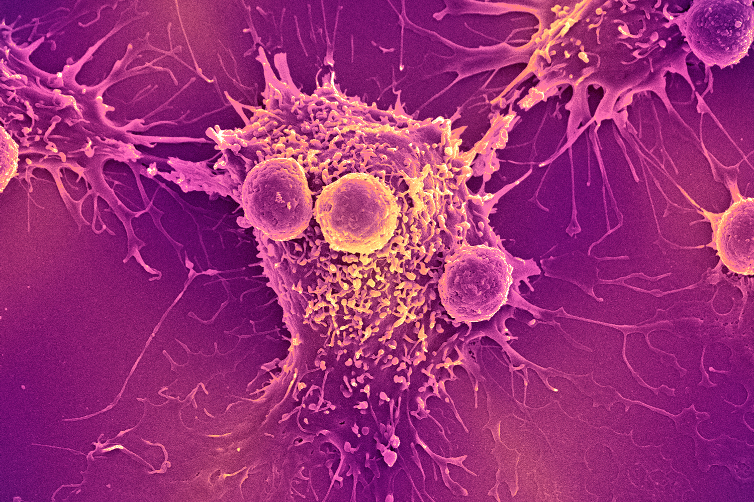 How Do Cancer Cells ‘Learn’ to Resist Treatment?