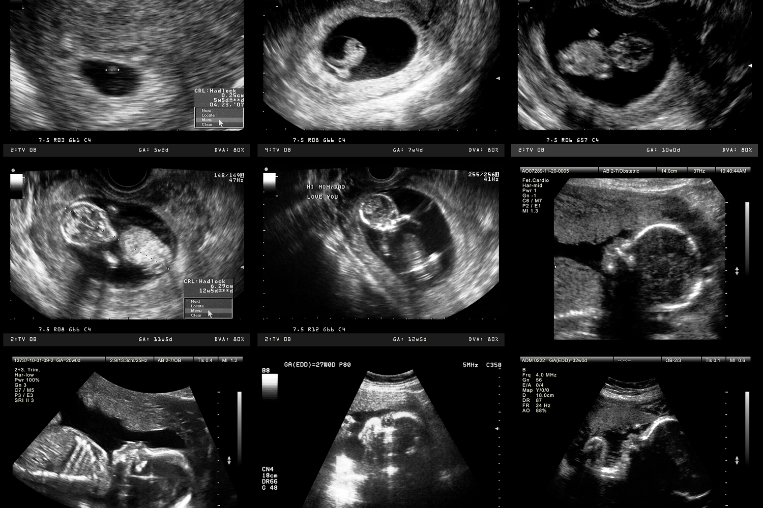 Exposure to &lsquo;Safer&rsquo; Plastic Additive During Pregnancy Linked to Smaller Birth Size