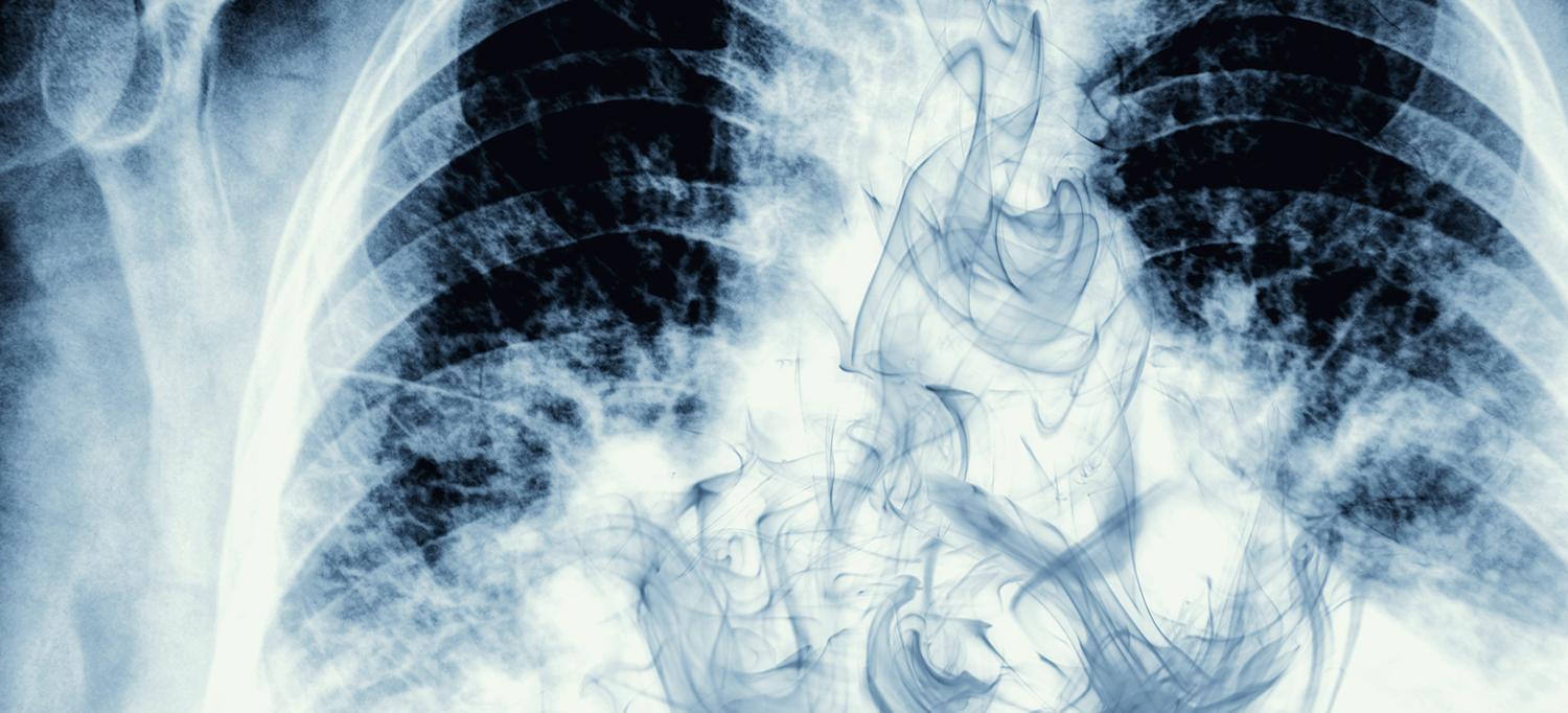 X-Ray Image of the Lungs