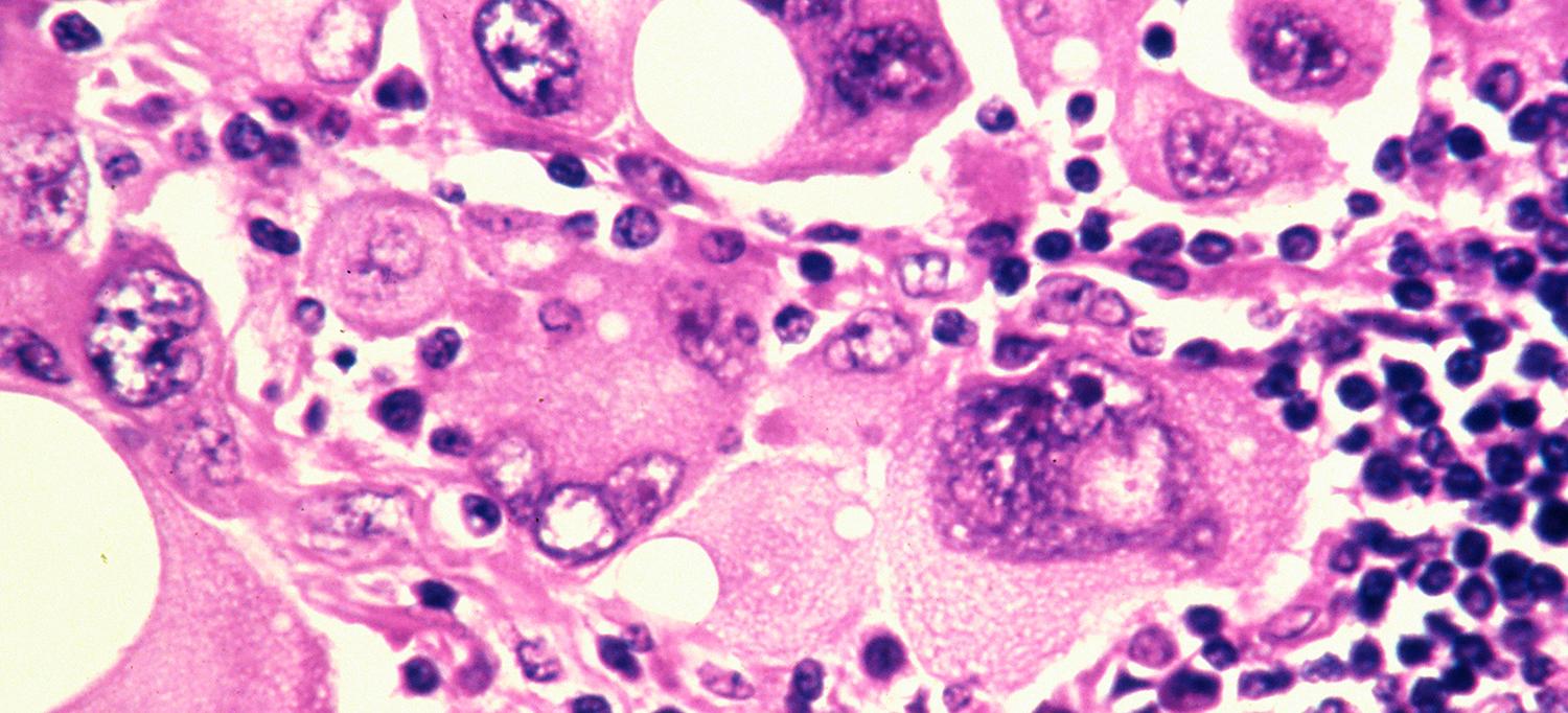 Human Metastatic Melanoma Cells