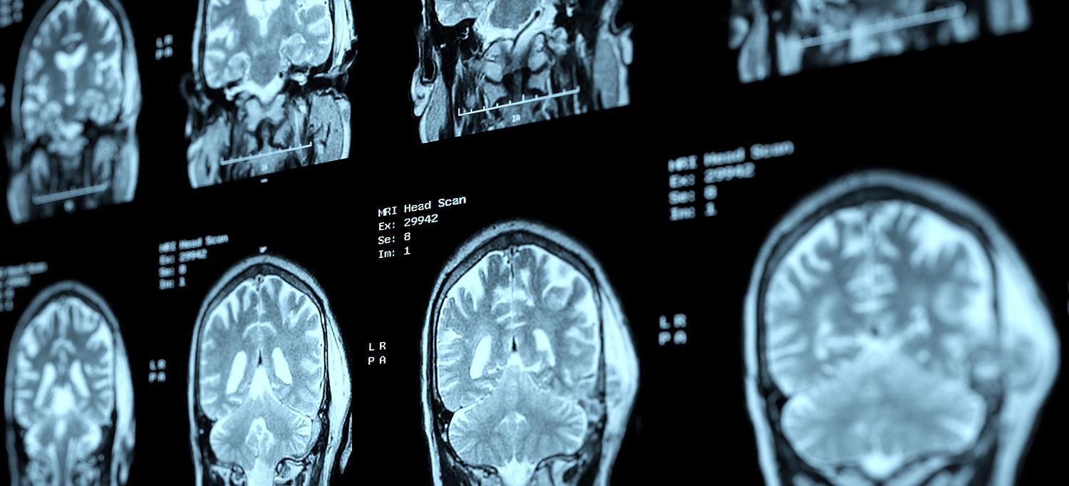 MRI Head Scan Results
