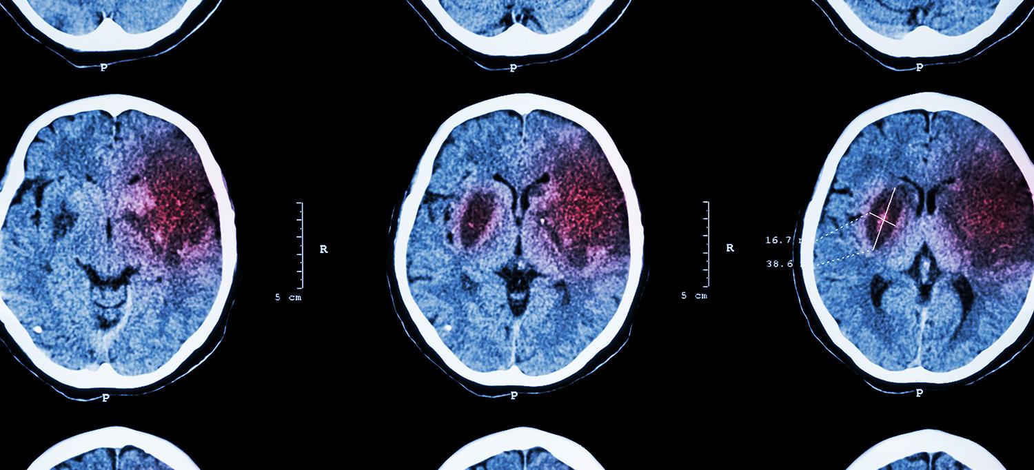 CT Scans of Brain with Ischemic Stroke