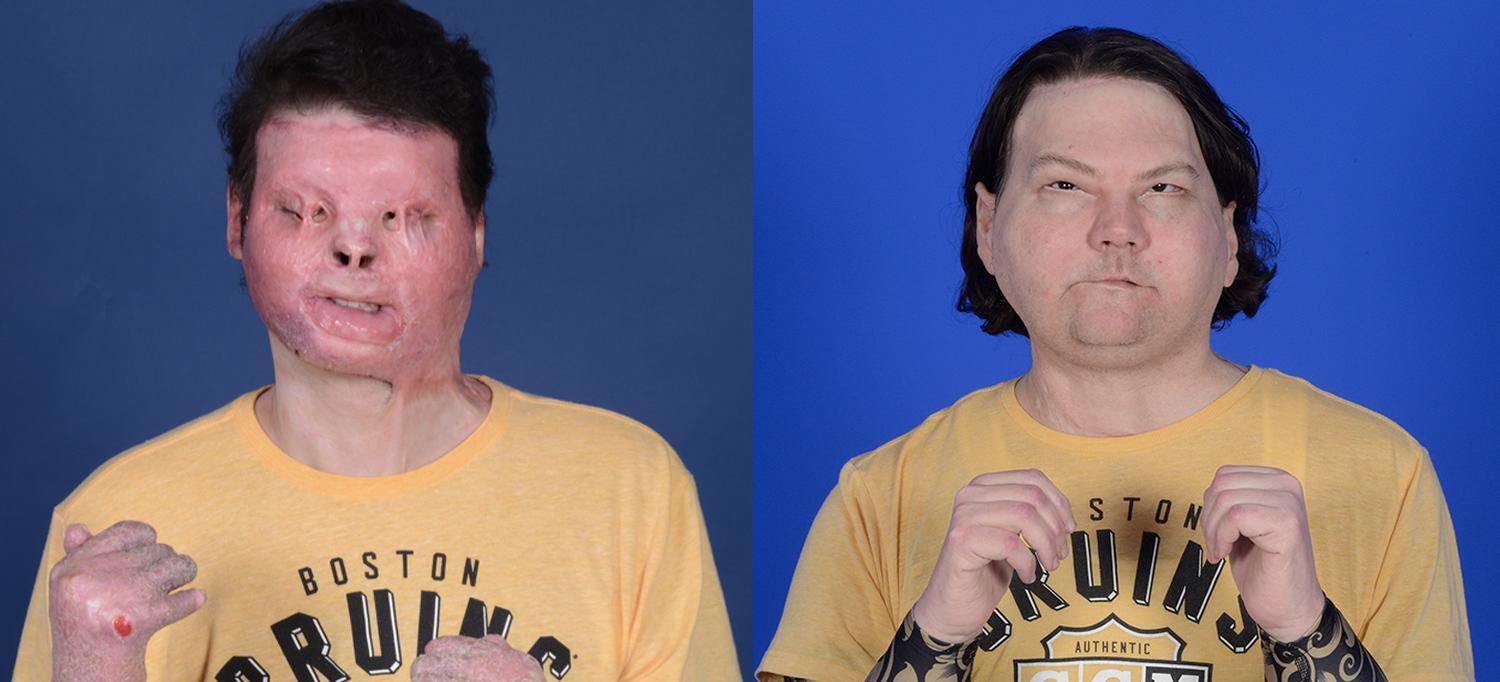 Joe DiMeo Before and After Surgery