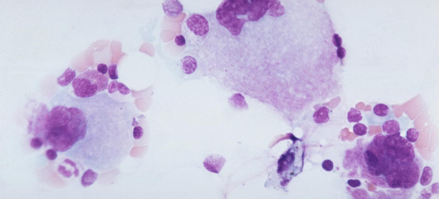 Thrombocytopenic Purpura of the Blood Platelets