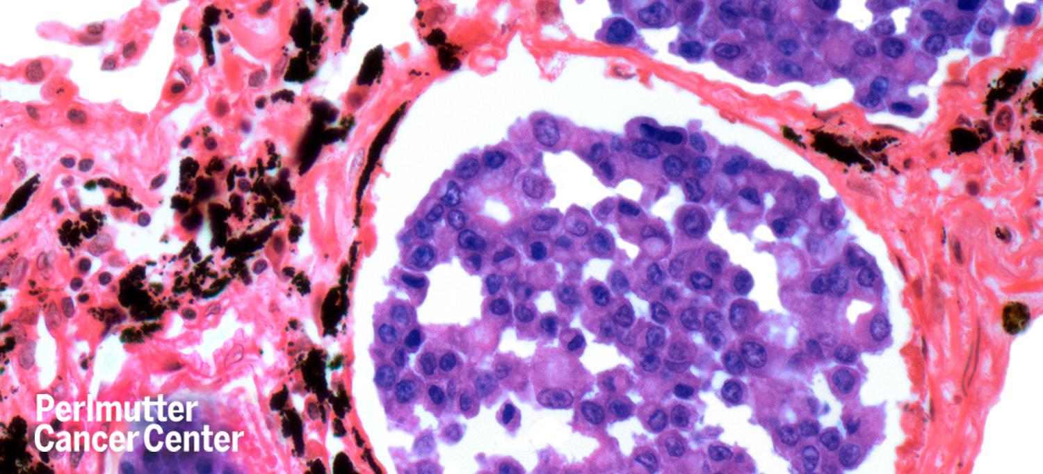 Light Micrograph of Section Through Secondary Lung Carcinoma
