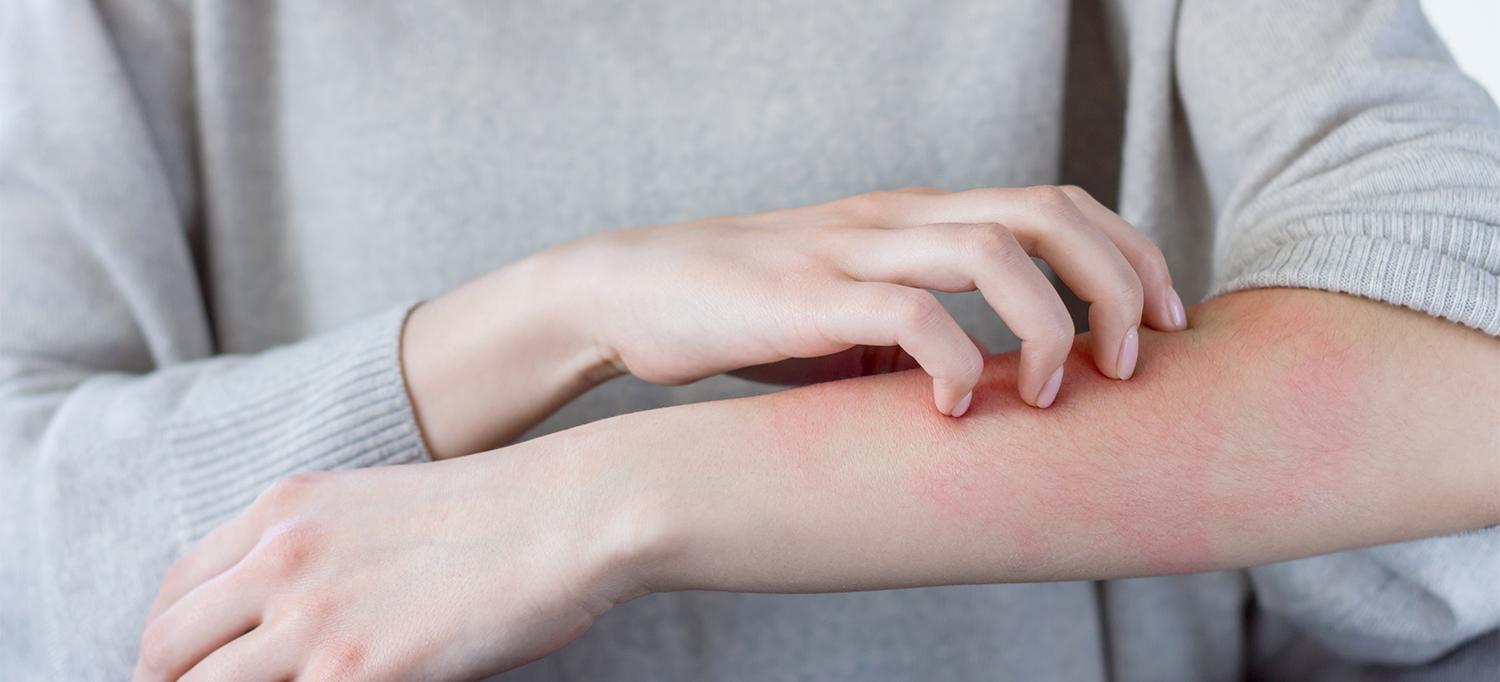 Person Scratching Red Rash on Arm
