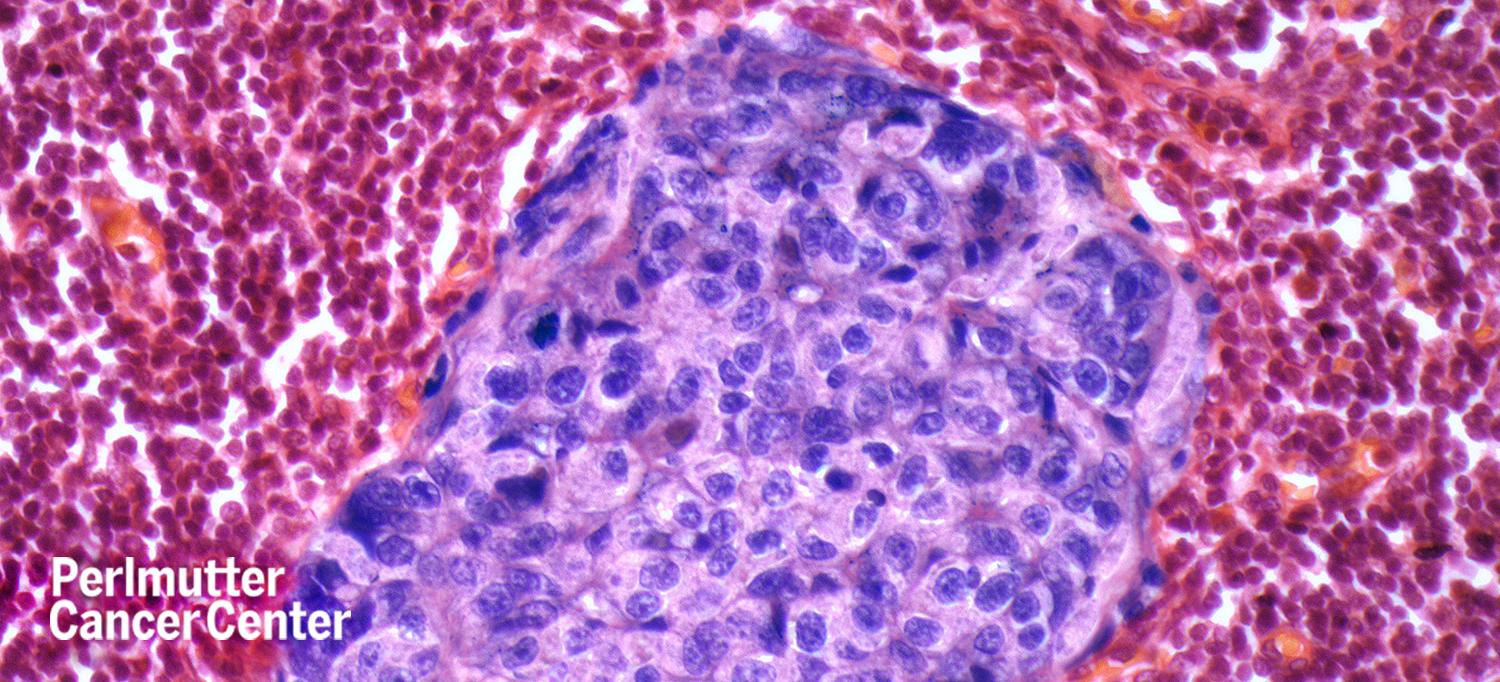 Light Micrograph of Lymph Node Section Showing Cancerous Tumor