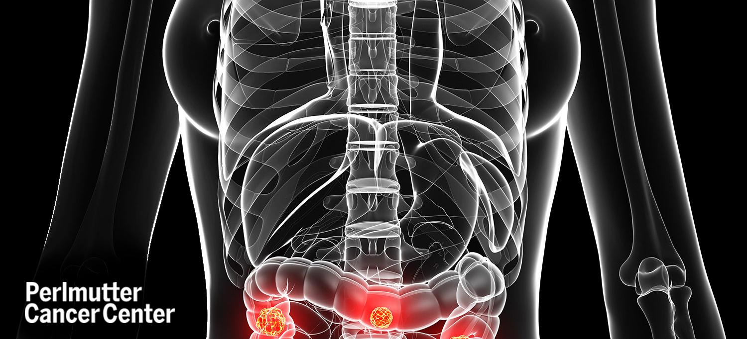 Computer Illustration of Colon Cancer