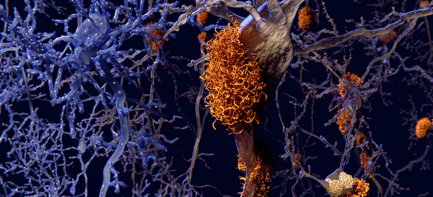 Brain Nerve Cells Affected by Alzheimer's Disease