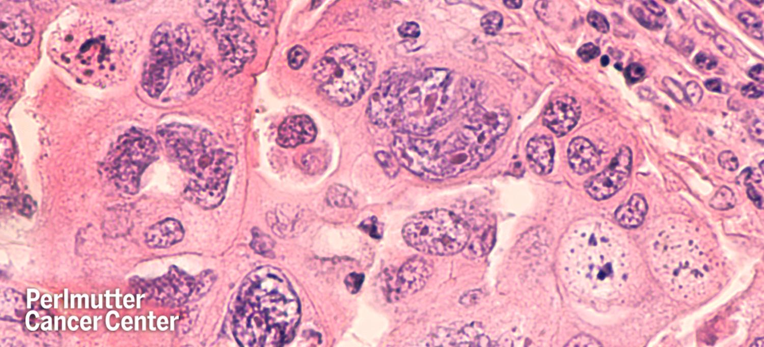 Serous Ovarian Cancer Cells
