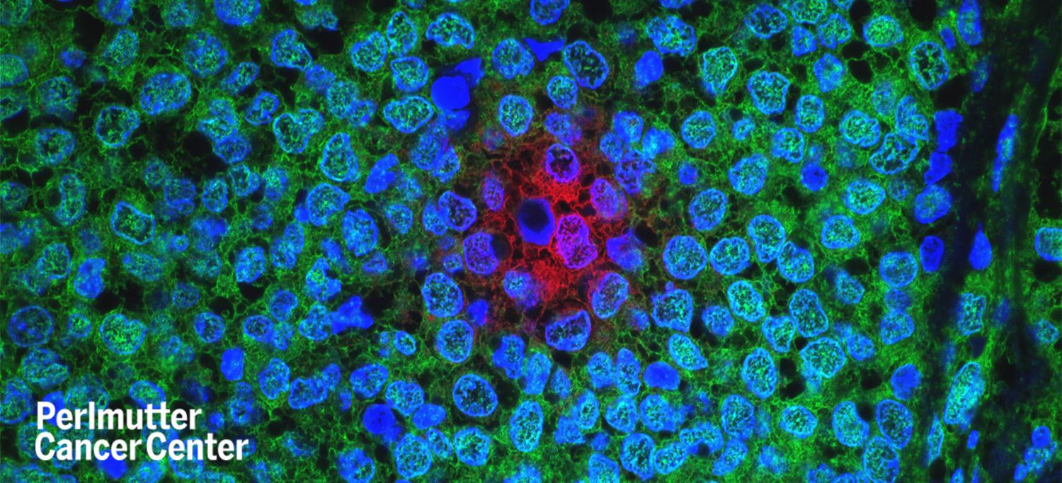 Breast Cancer Cells Resisting Treatment