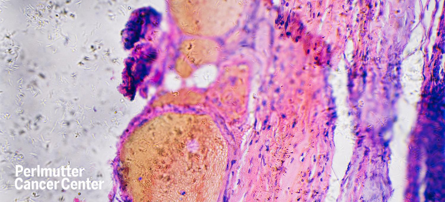 Human Melanoma Cancer Cells Under Microscope