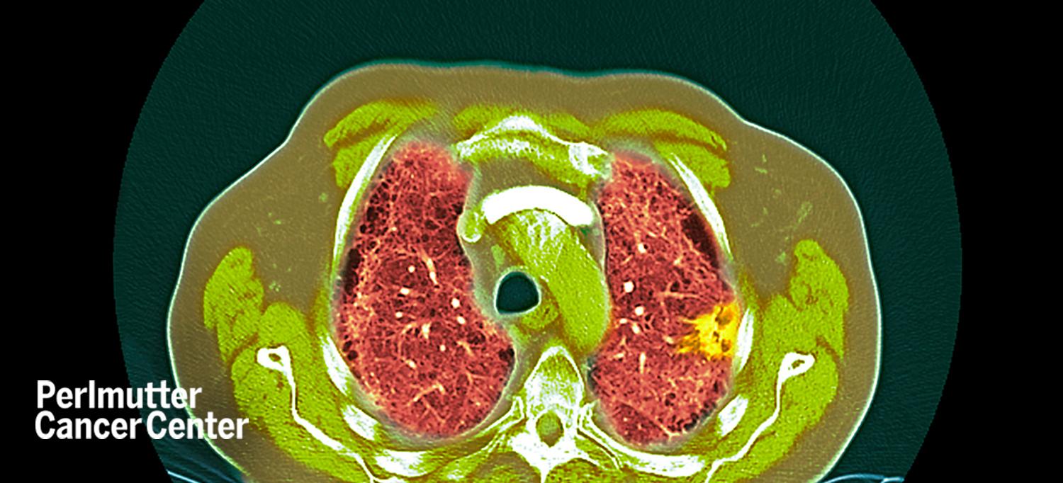 CT Scan Showing Lung Cancer