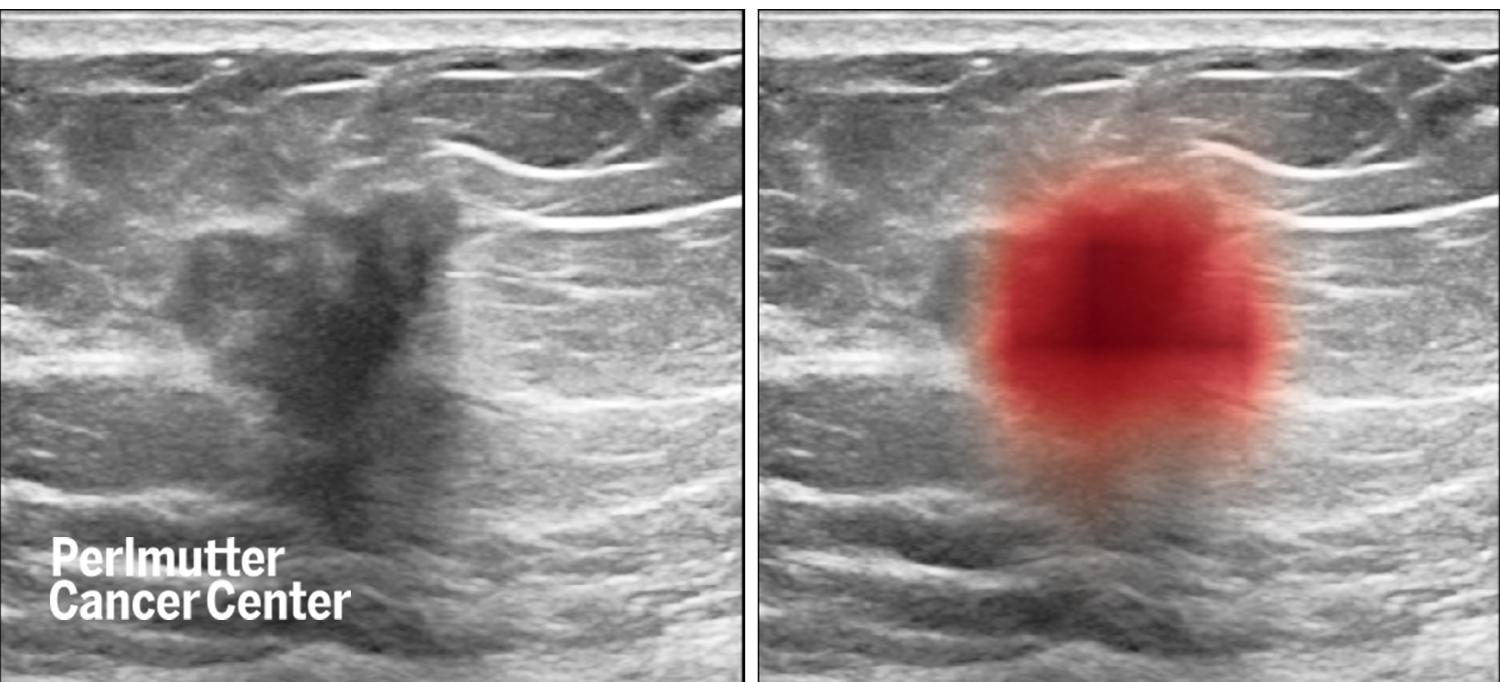 Breast Ultrasound Images