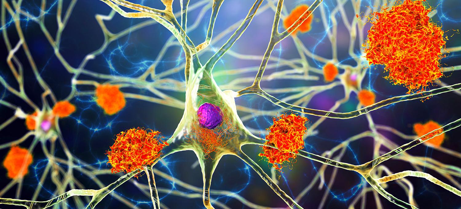 Neurons in Alzheimer's Disease