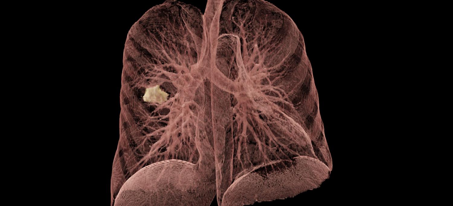 CT Chest Scan Showing Lung Cancer