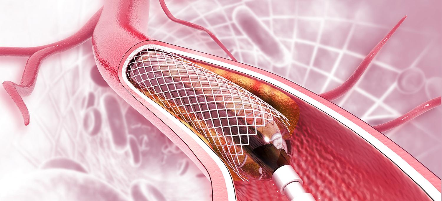 Placing a Stent