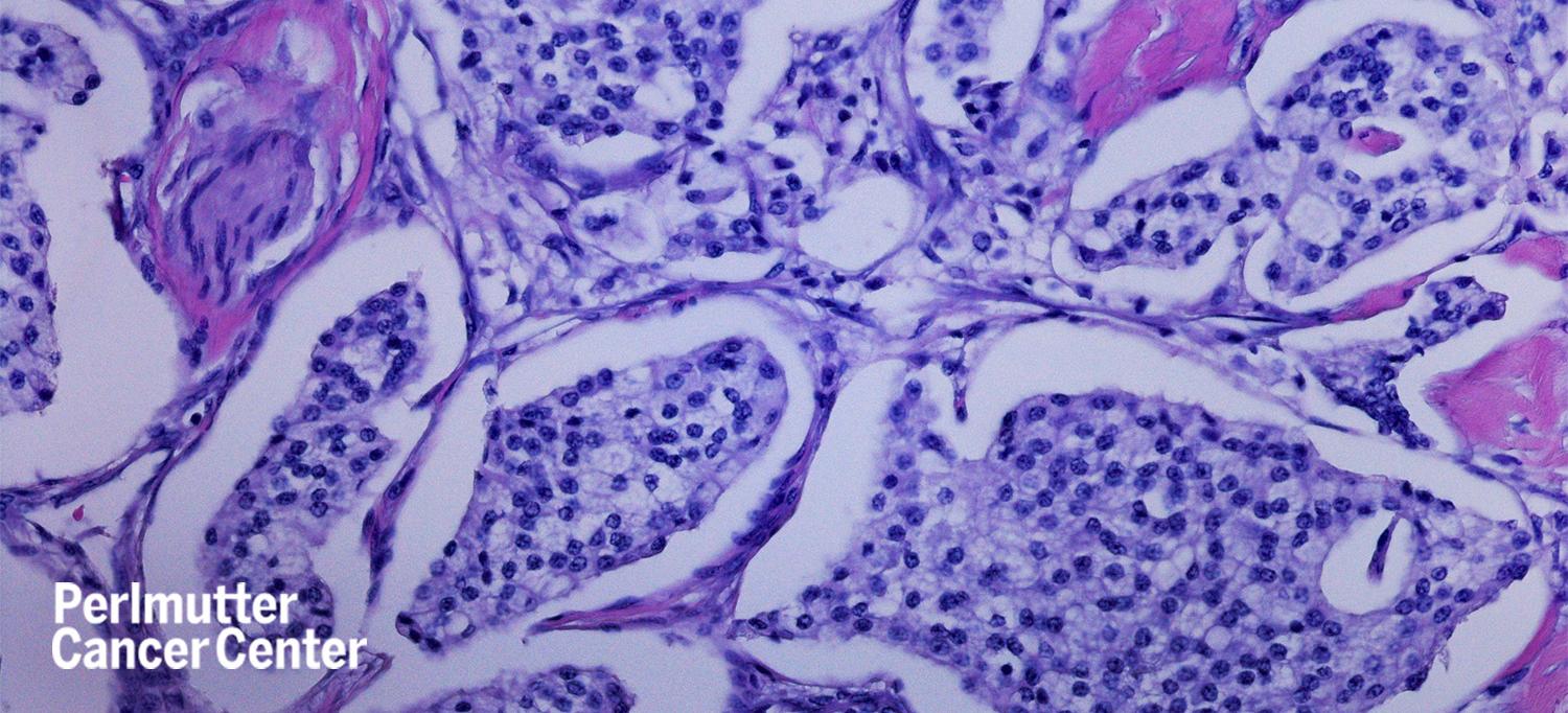 Micrograph of Pancreatic Neuroendocrine Tumor