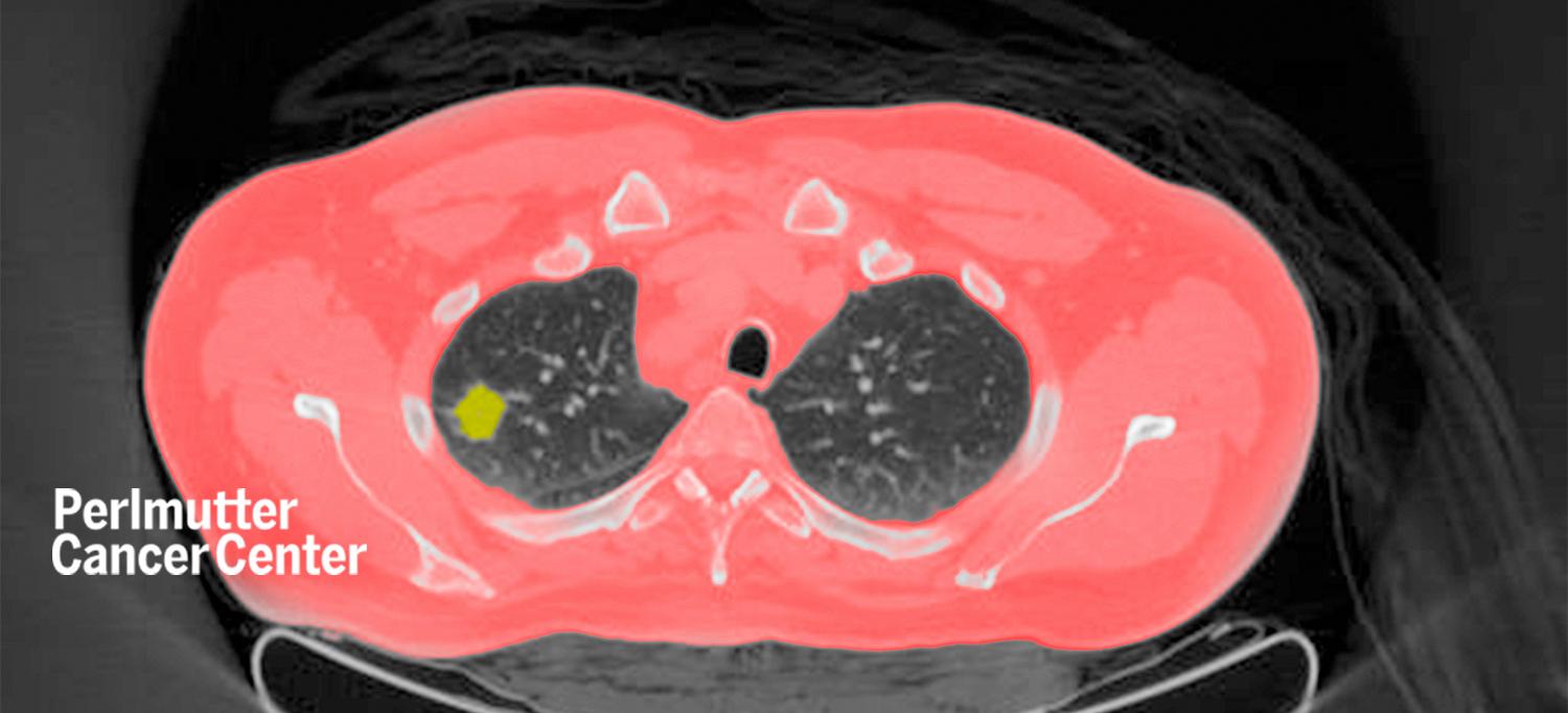 Chest CT Scan of Lung Tumor