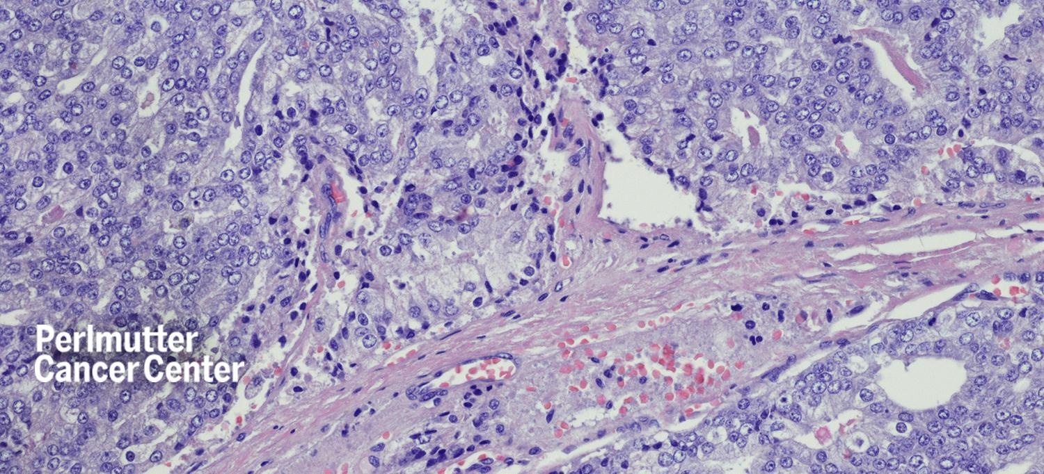 Micrograph of Metastatic Prostate Carcinoma