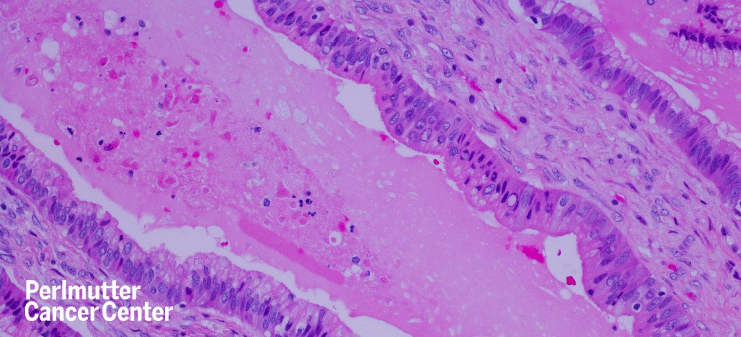 Metastatic Pancreatic Cancer Cells