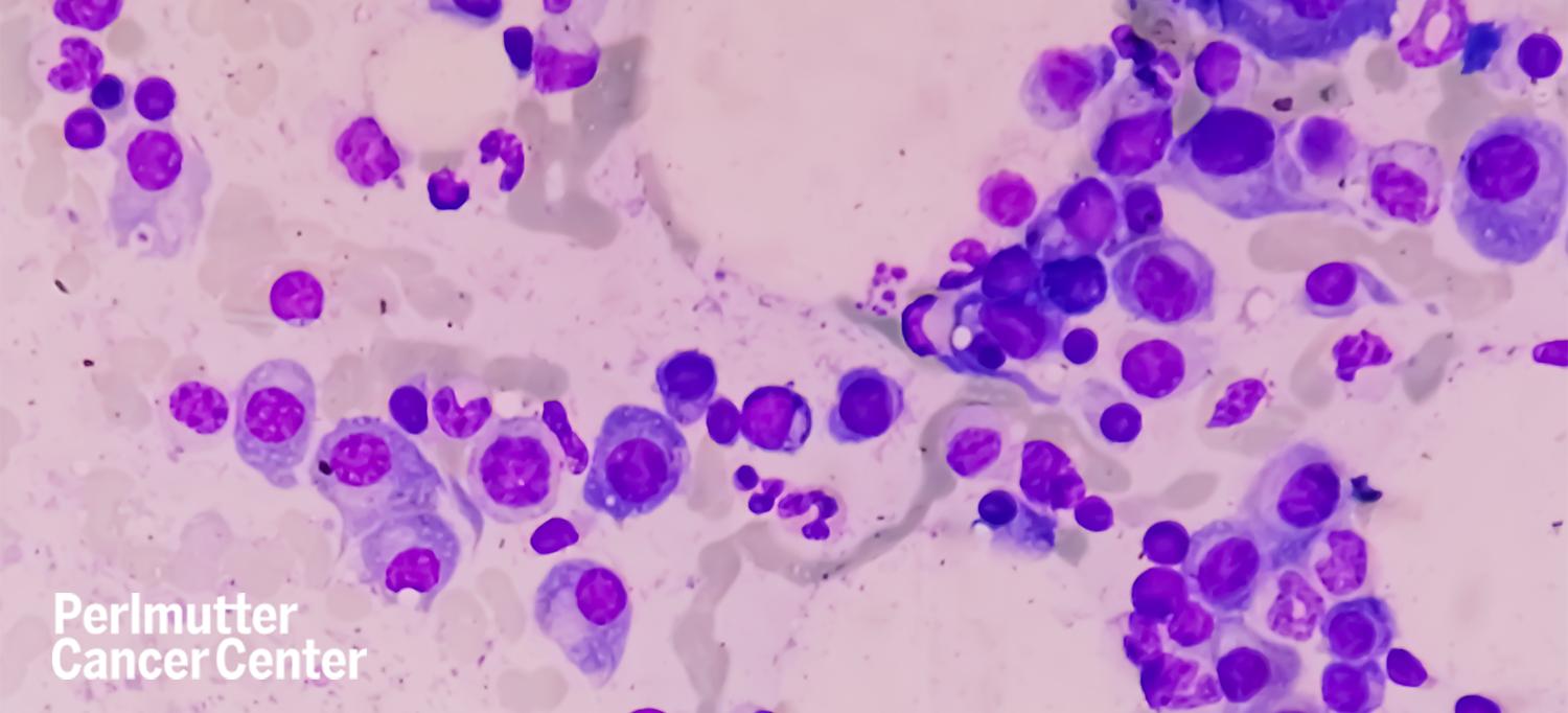 Microscopic View of Bone Marrow Slide with Features Suggestive of Multiple Myeloma