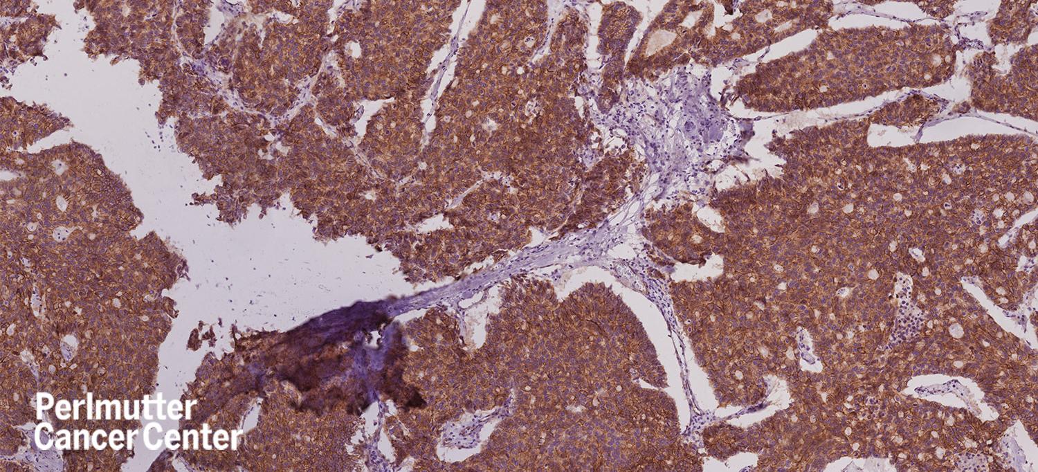Immunohistochemical Staining of Pancreatic Cancer Cells