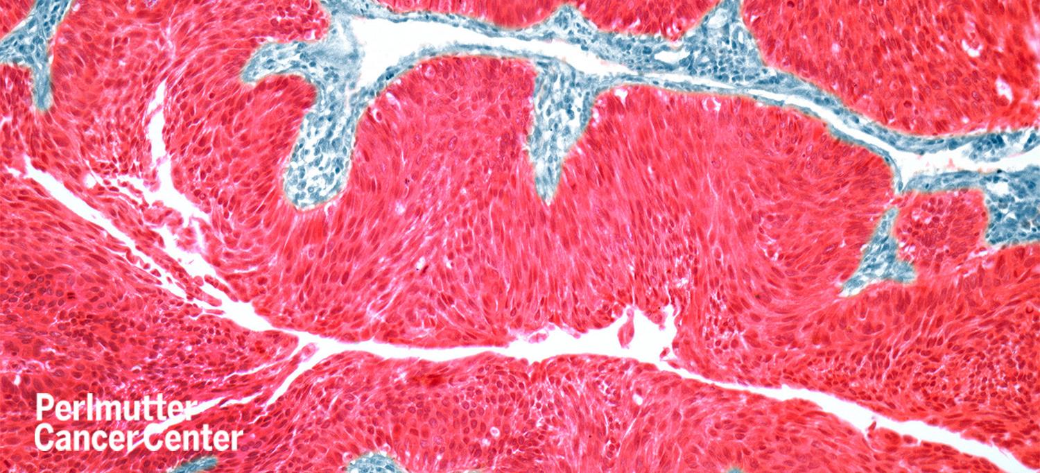 Light Micrograph of Bladder Cancer Cells